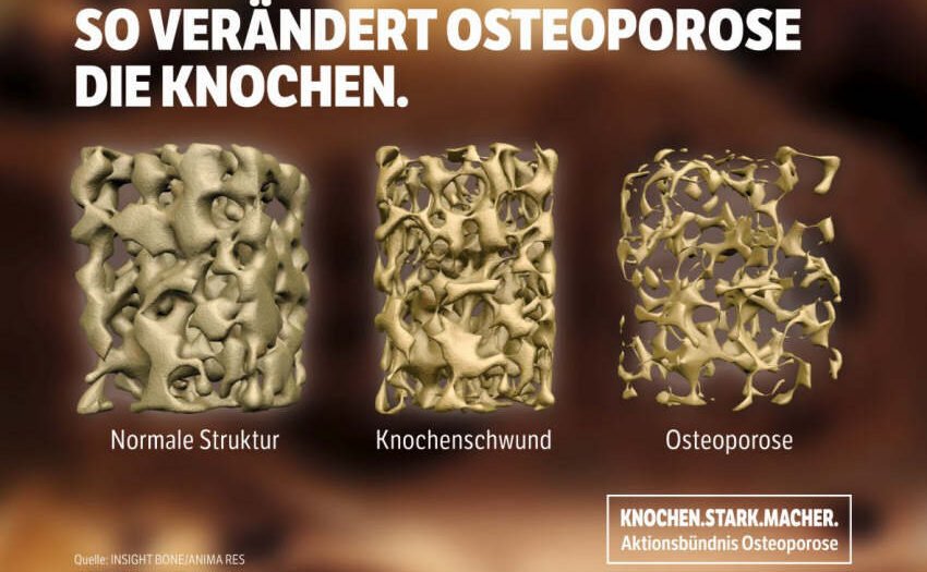 Osteoporose führt zu immensen Beeinträchtigungen
