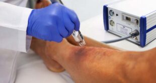 Kaltplasma Wundbehandlung - neoplas med